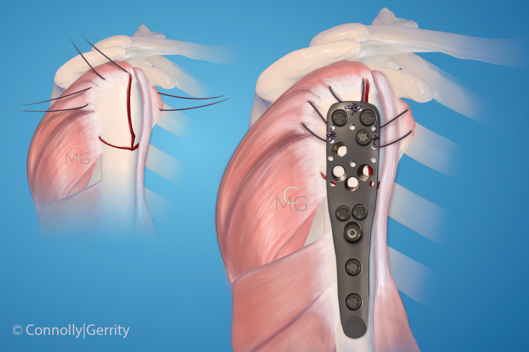 Proximal Humerus