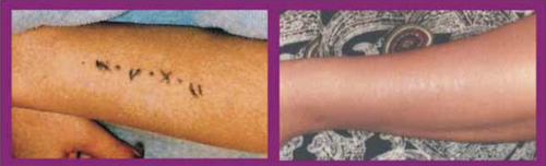 tattoo-removal-arm.png