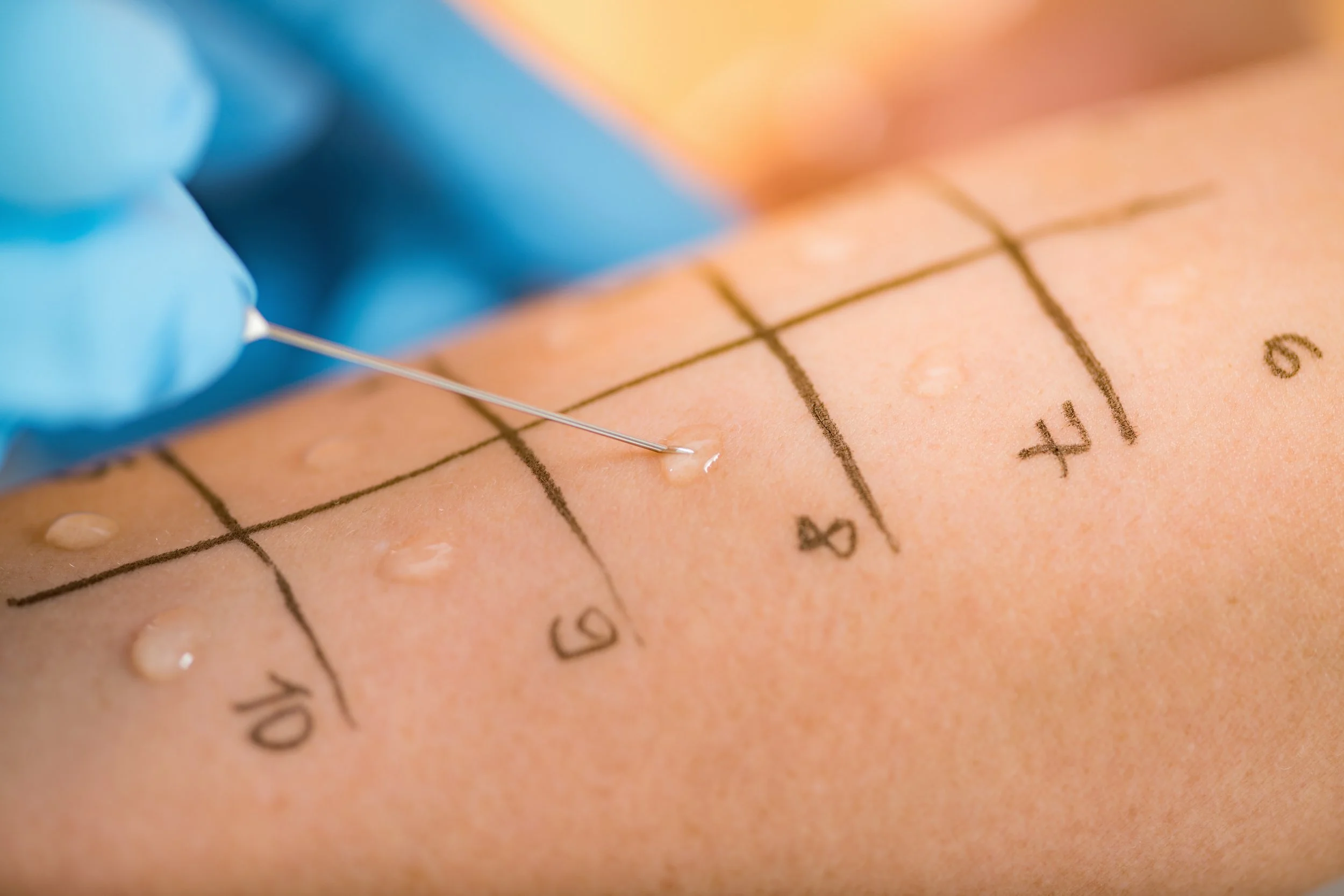 Allergy Testing vs. Allergy Medication: Which Is Right for You?