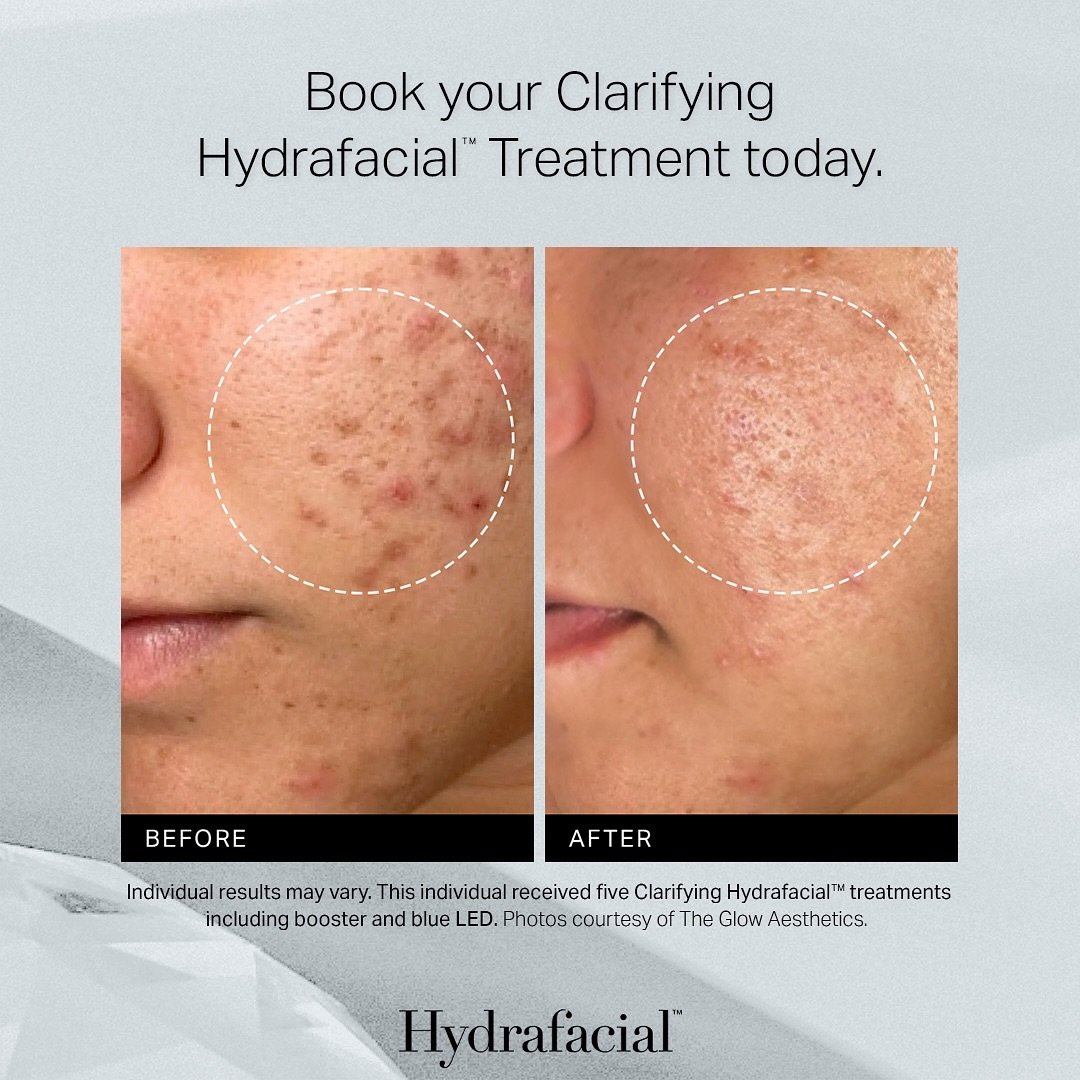 Looking for a breakout buster treatment that actually works? Book a Hydrafacial with one of our artists and let them know you want the Clarifying Treatment! #LessAcneMoreGlow ✨
@hydrafacial