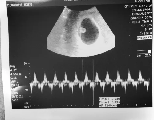 6 weeks ish - baby? or wart?