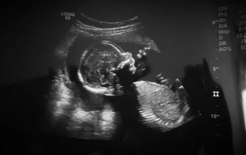 Umbilical bubbles!