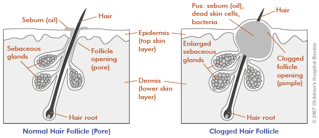 Comparison of a normal pilosebaceous unit to a blocked one, with formation of a microcomedo. Image credit http://youngmenshealthsite.org/guides/acne/