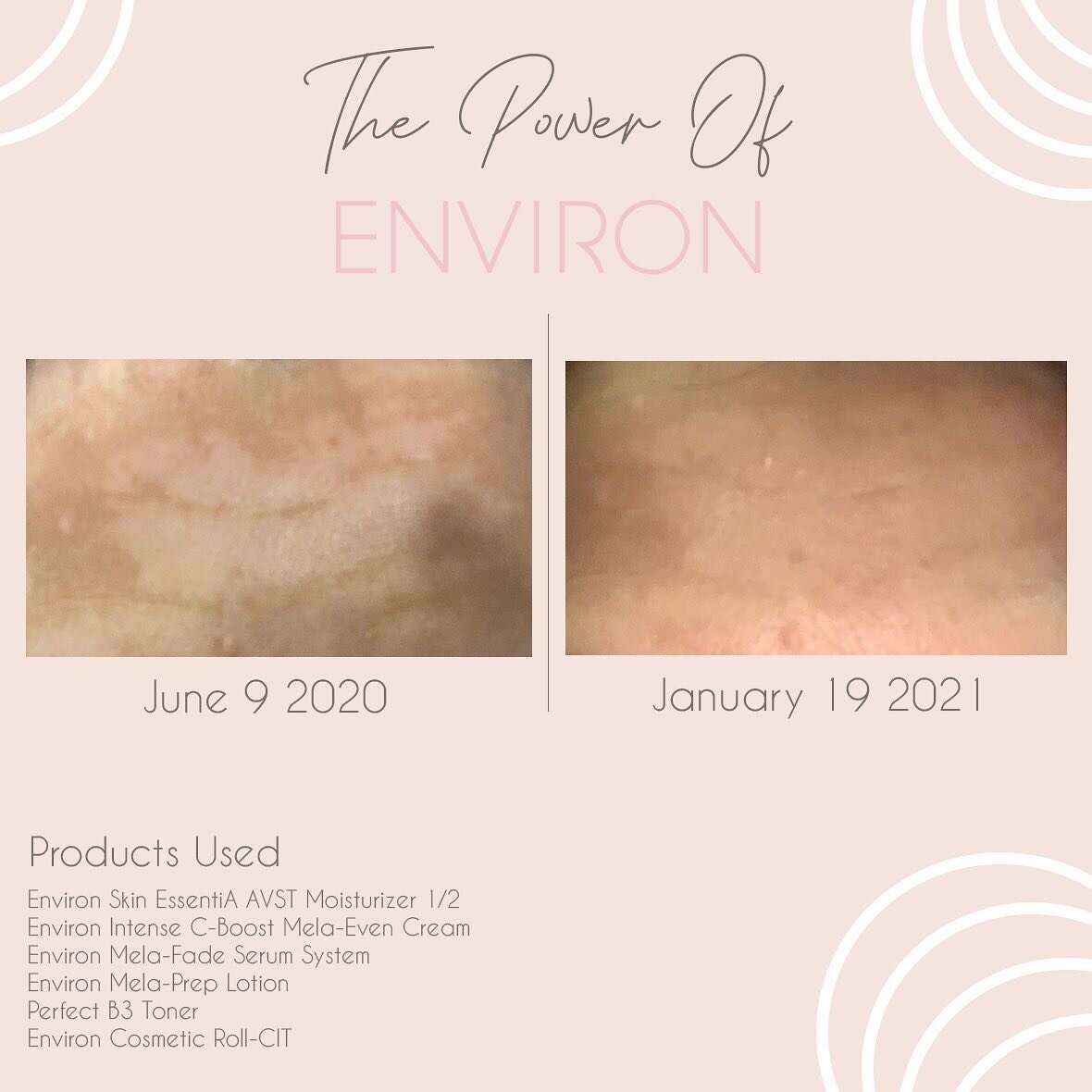 This is a before and after of my client, just 7 months on Environ. This client came to me with SEVERE melasma and sun damage. We introduced AVST, derma-roller, and the Radiance products (listed) and her melasma is 70-80 % gone.  If you have suffered 
