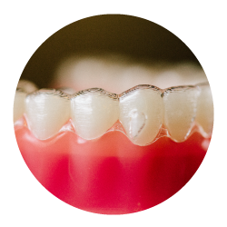 Invisalign clear aligner