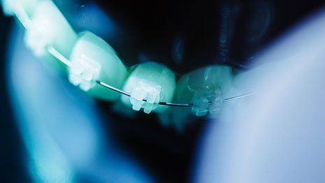 Braces