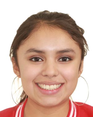Girl with front teeth straightened