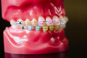 Side view of tooth model with colorful braces