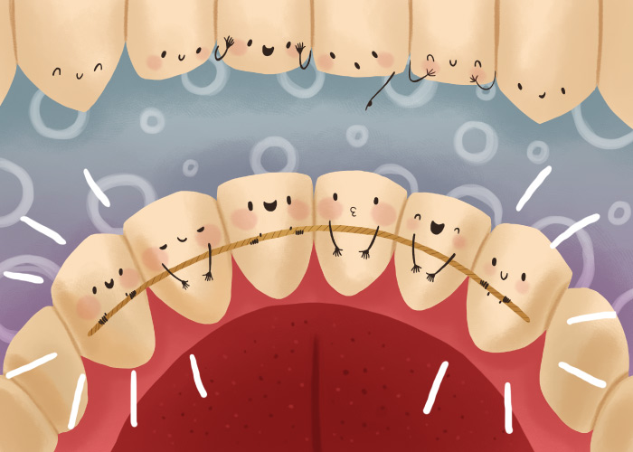 How To Floss Front Teeth With Permanent Retainer