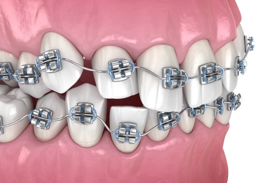 What Cases Are Braces Best For