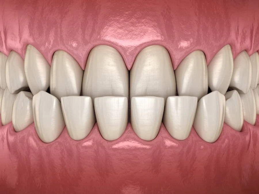 Can Braces Fix an Underbite?