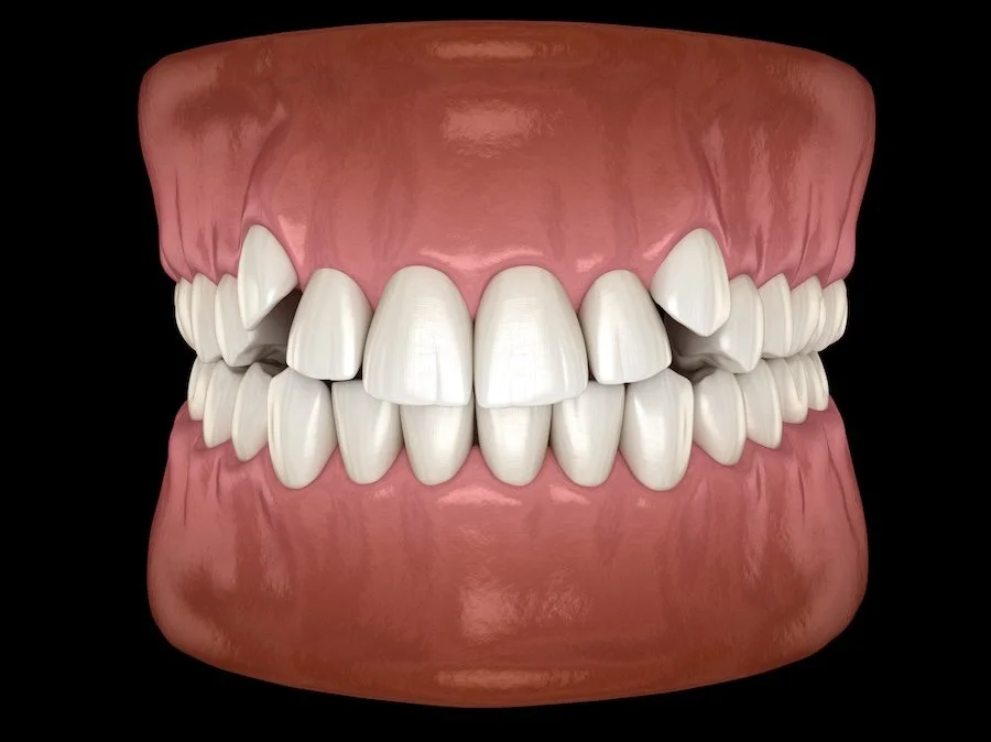 Signs Your Child May Need to See an Orthodontist in Springdale, AR