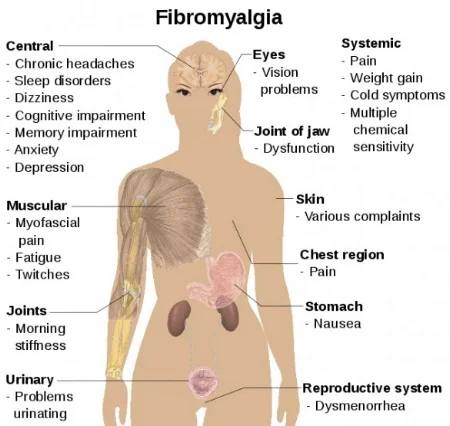fibromyalgia-585x555.jpg