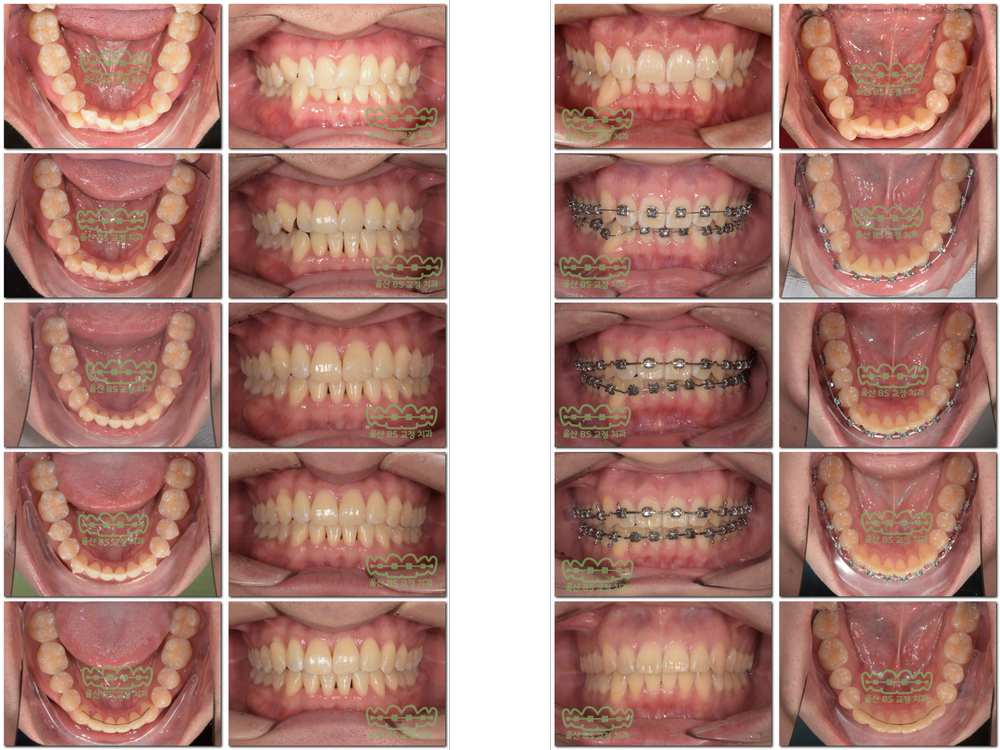 포천교정과는 다양한 교정기기를 보유하고 있어 선택의 폭이 넓습니다. 8
