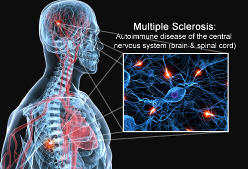 Pain Associated with Multiple Sclerosis