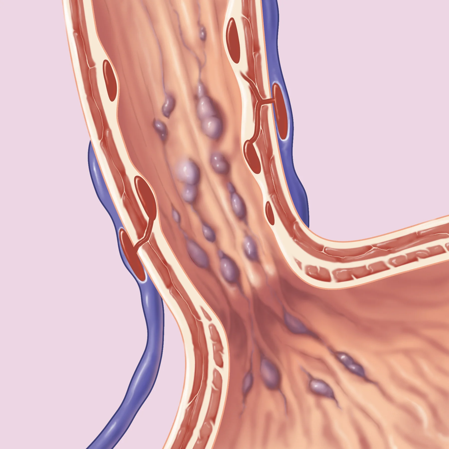 Esophageal Varices
