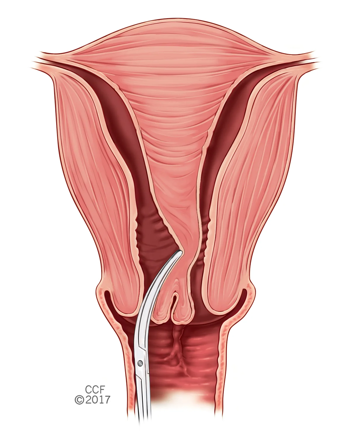 Hysterectomy Pt.1