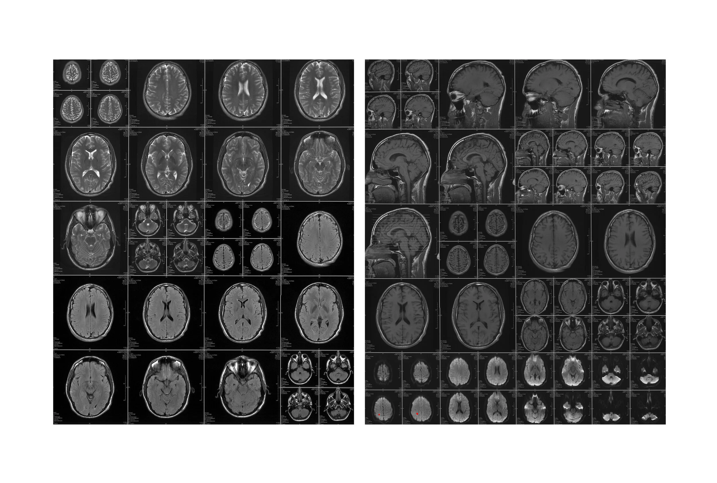  My Brother, Storme’s Brain Scans. 