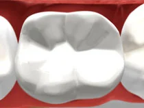 Tooth-Coloured Fillings