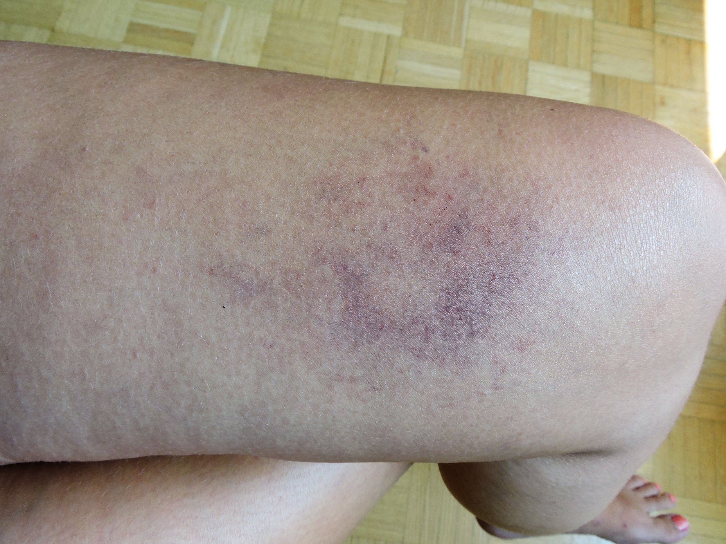 bruise4.jpg