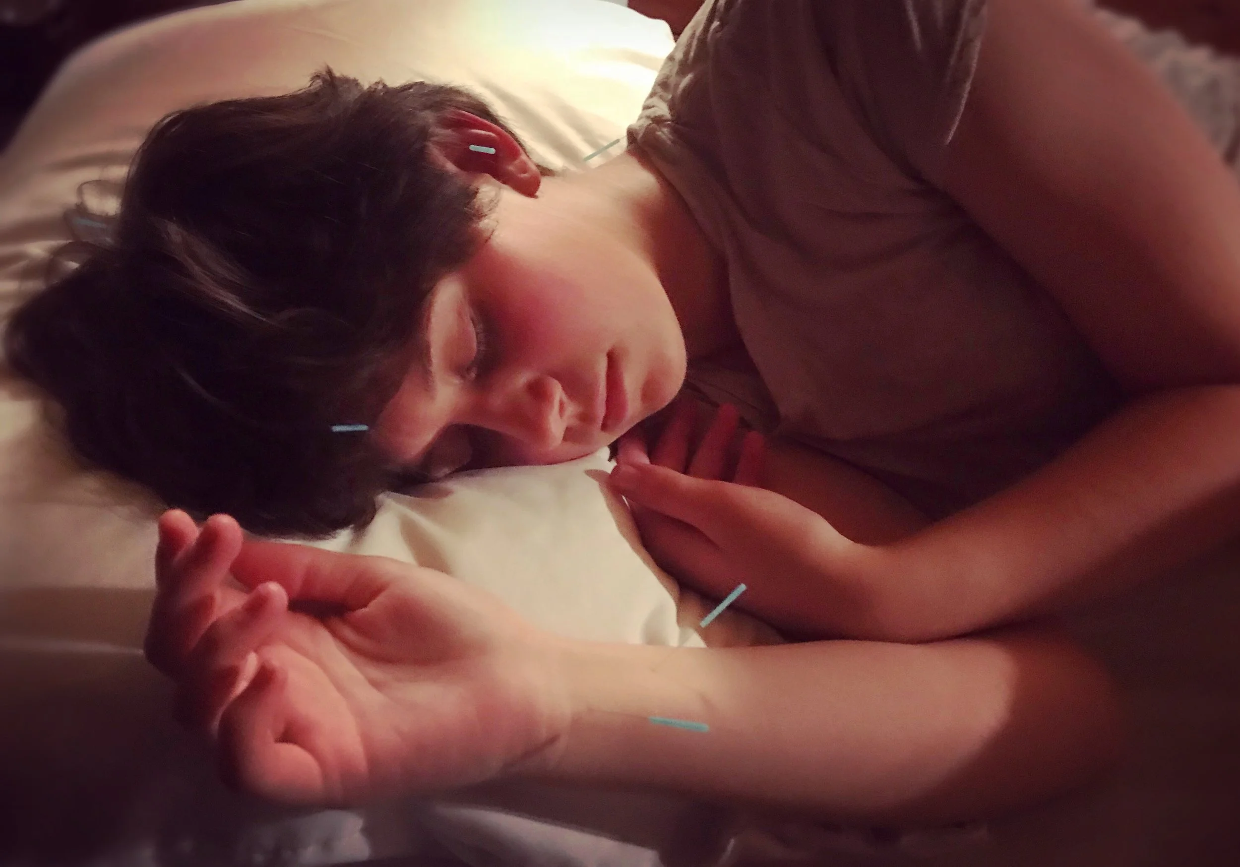 Teenager Receiving Acupuncture