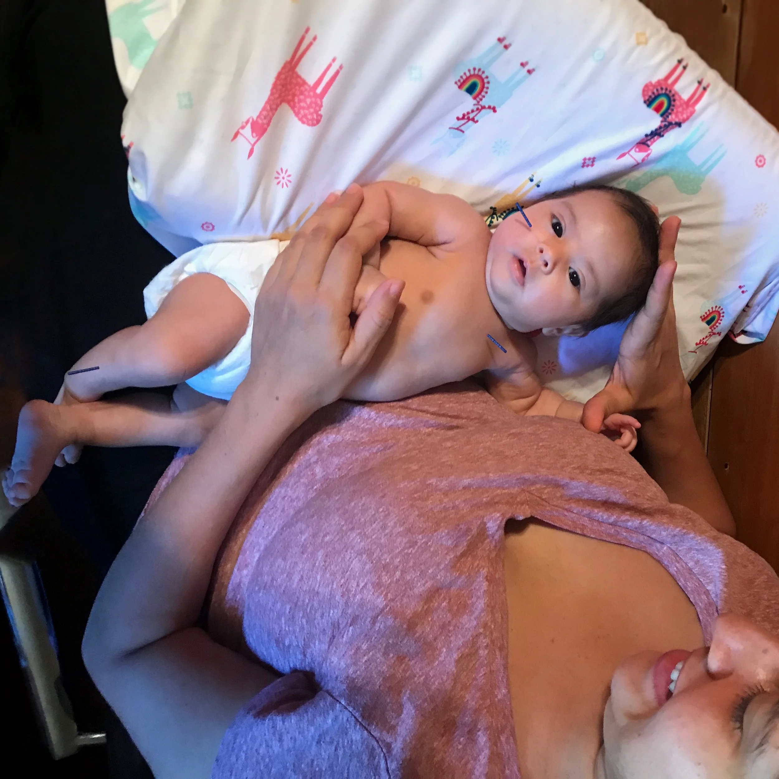 Baby receiving acupuncture while in their mother's arms