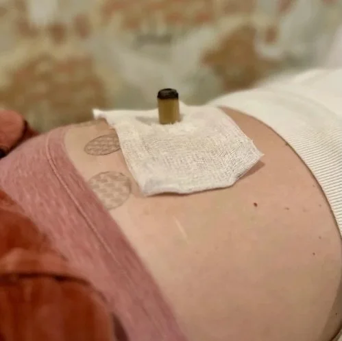 Fertility Acupuncture

Chinese Medicine and Acupuncture have been used for thousands of years to help women conceive. Whether you are trying naturally or using assisted reproductive technology, at Therapeutic Bodywork we take a comprehensive approach