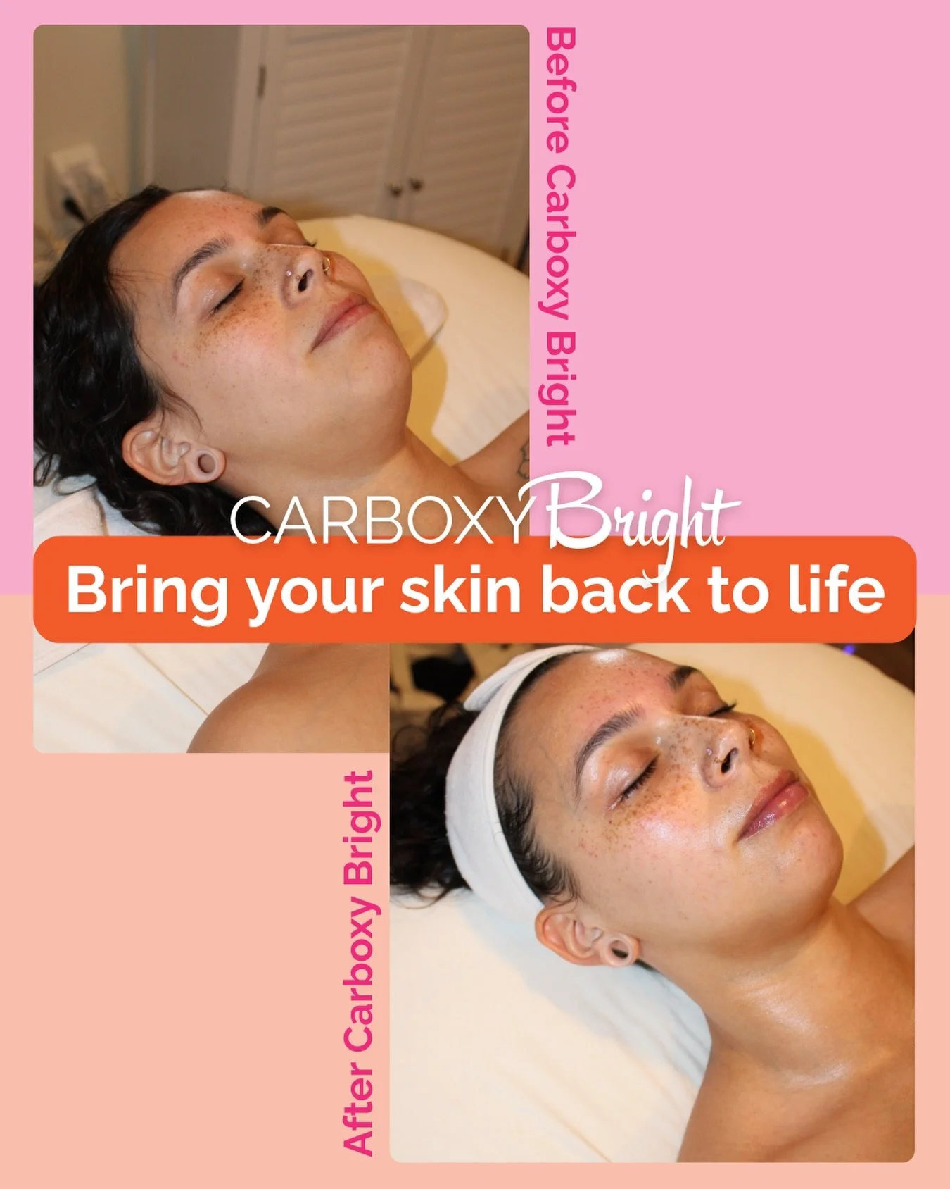 Instantly revive dull, tired skin while supporting long-term skin health with our Carboxy Bright Facial ✨