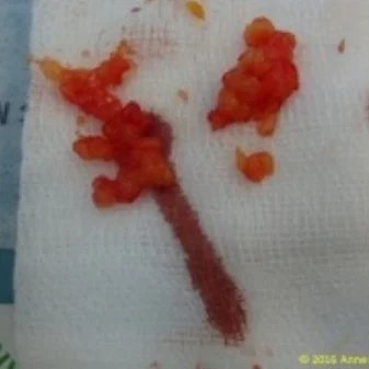 Fat nodules extracted by Dr Anne Dancey (UK)