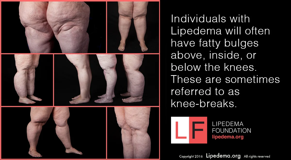 Knee fat