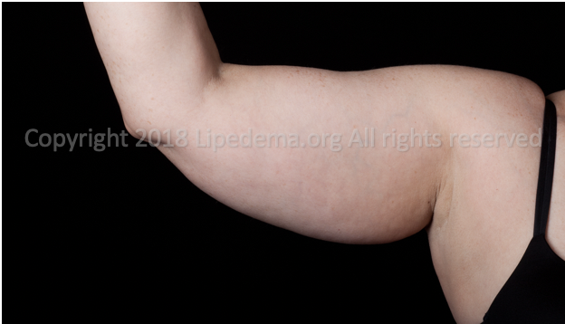 Fat buildup in upper arms (front view). For more images go here .