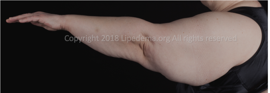 Fat buildup in upper arms (side view). For more images go here .