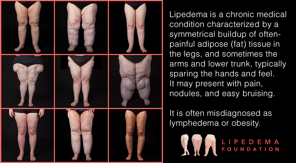 LippyLegs_Collage_Social.png