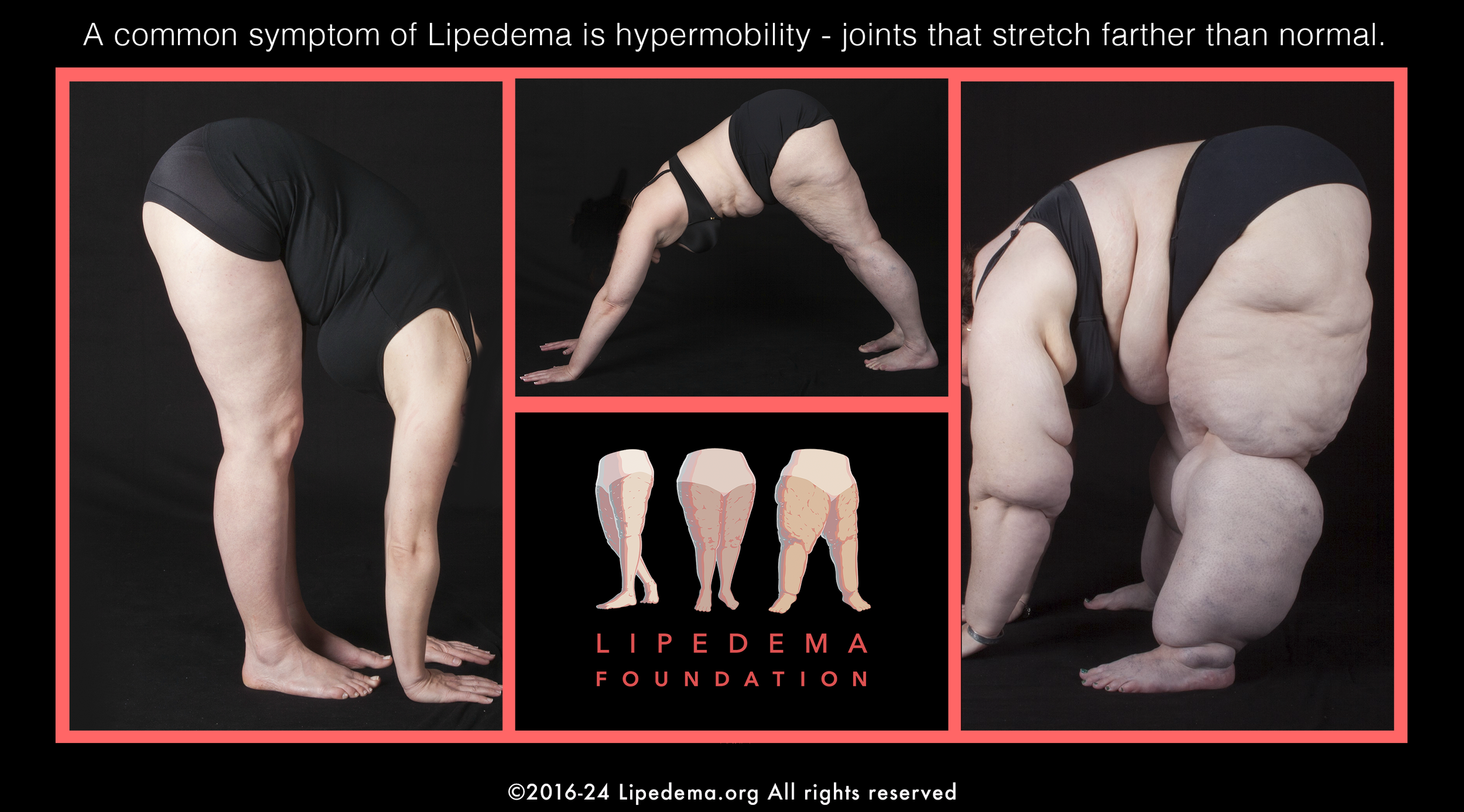 Lipedema Foundation Hypermobility