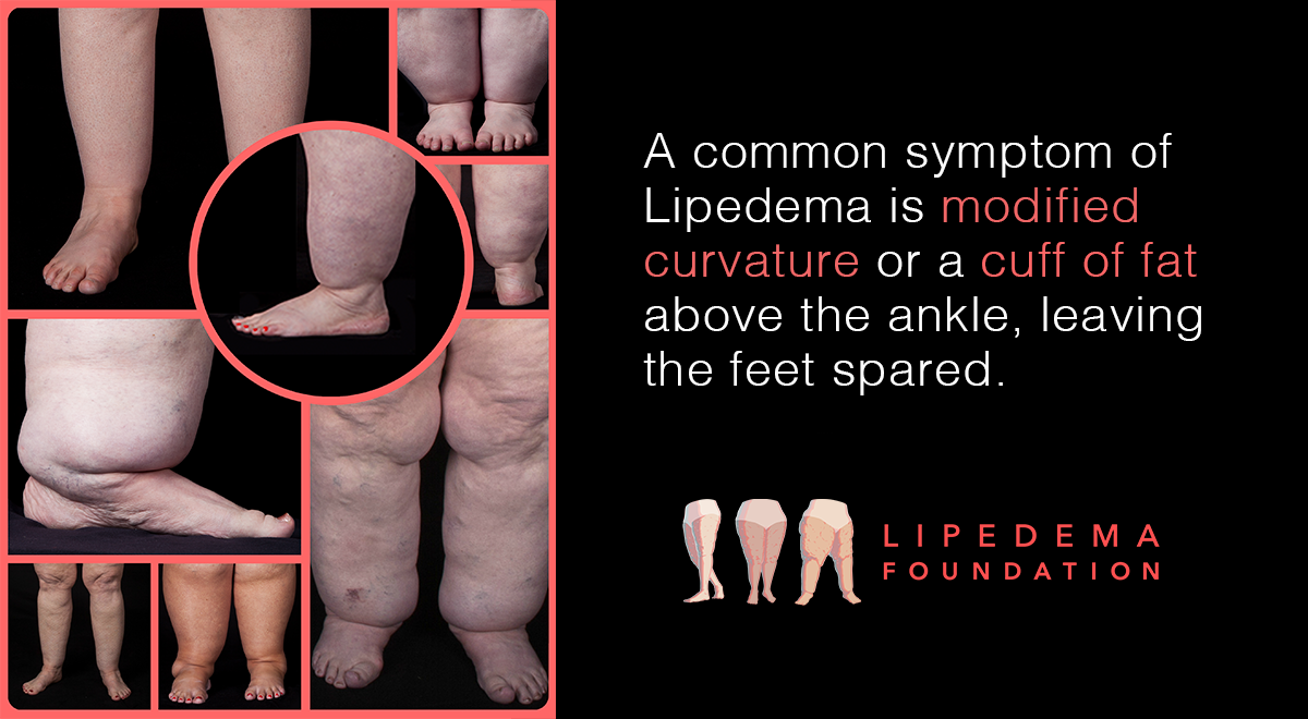 Lipedema Foundation Photo Stories Modified Curvature