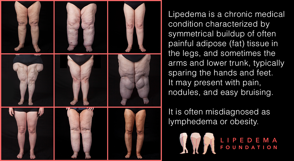 Lipedema Foundation Photo Stories Symmetrical Buildup