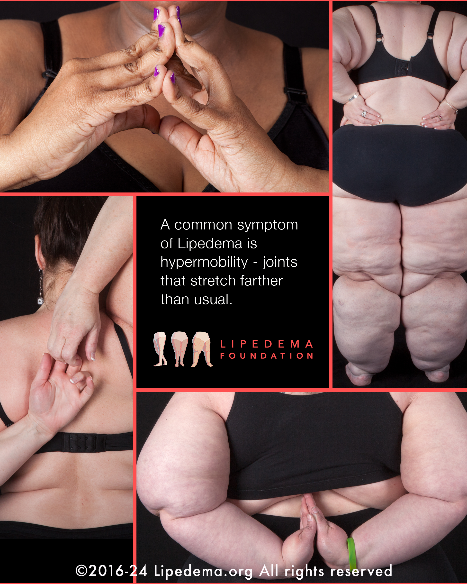 Lipedema Foundation Photo Stories Hypermobility