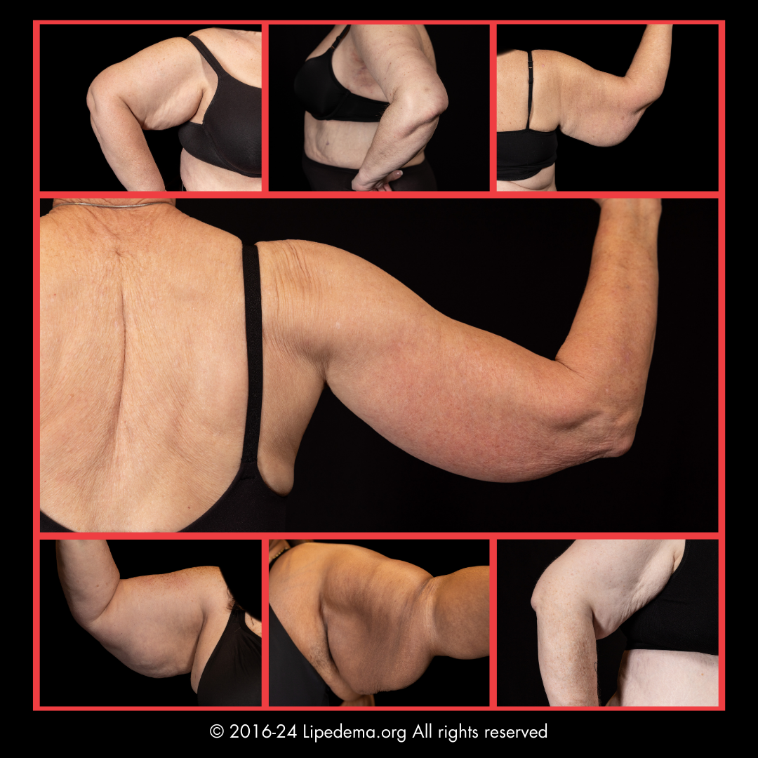 Lipedema Foundation Photo Stories Lipedema in Arms