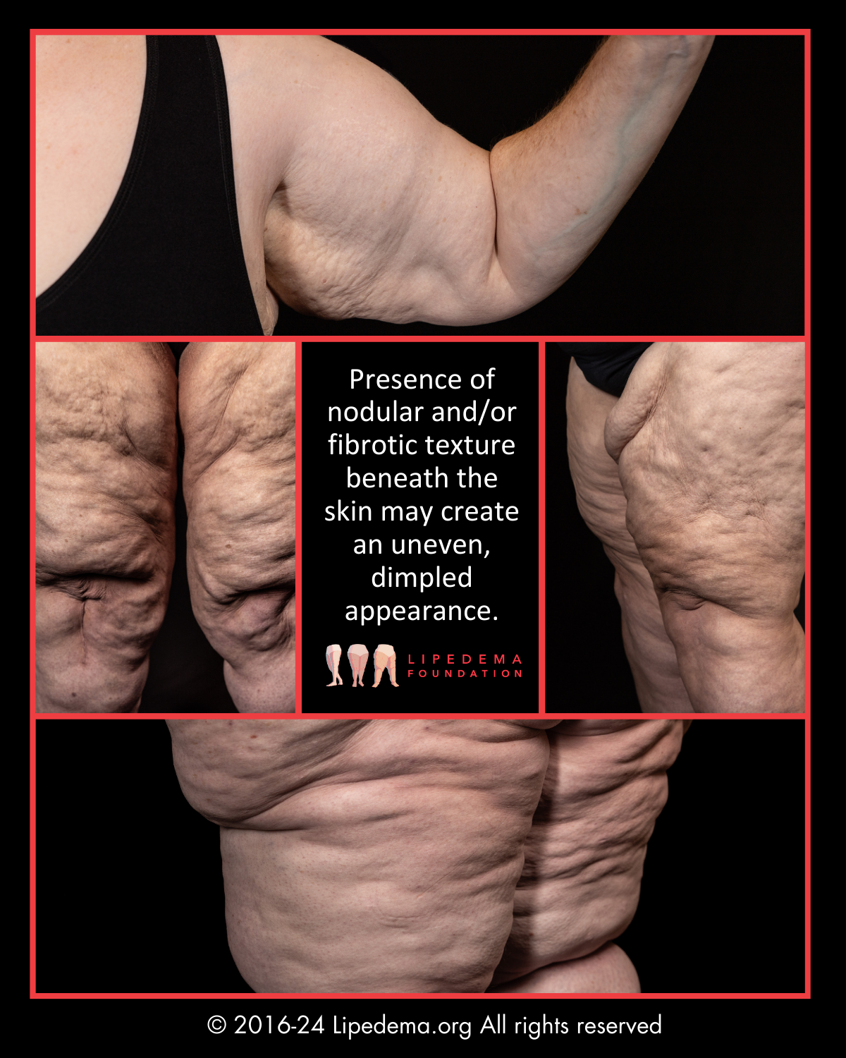 Lipedema Foundation Nodular Lipedema
