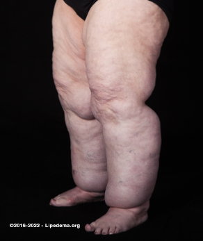 Is fat in the legs lipoedema or obesity? - Richard Evans Vascular