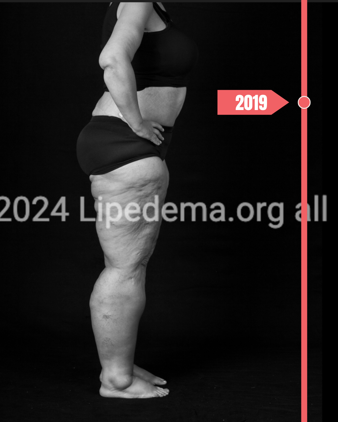 2019 Lipedema Foundation Research Impact