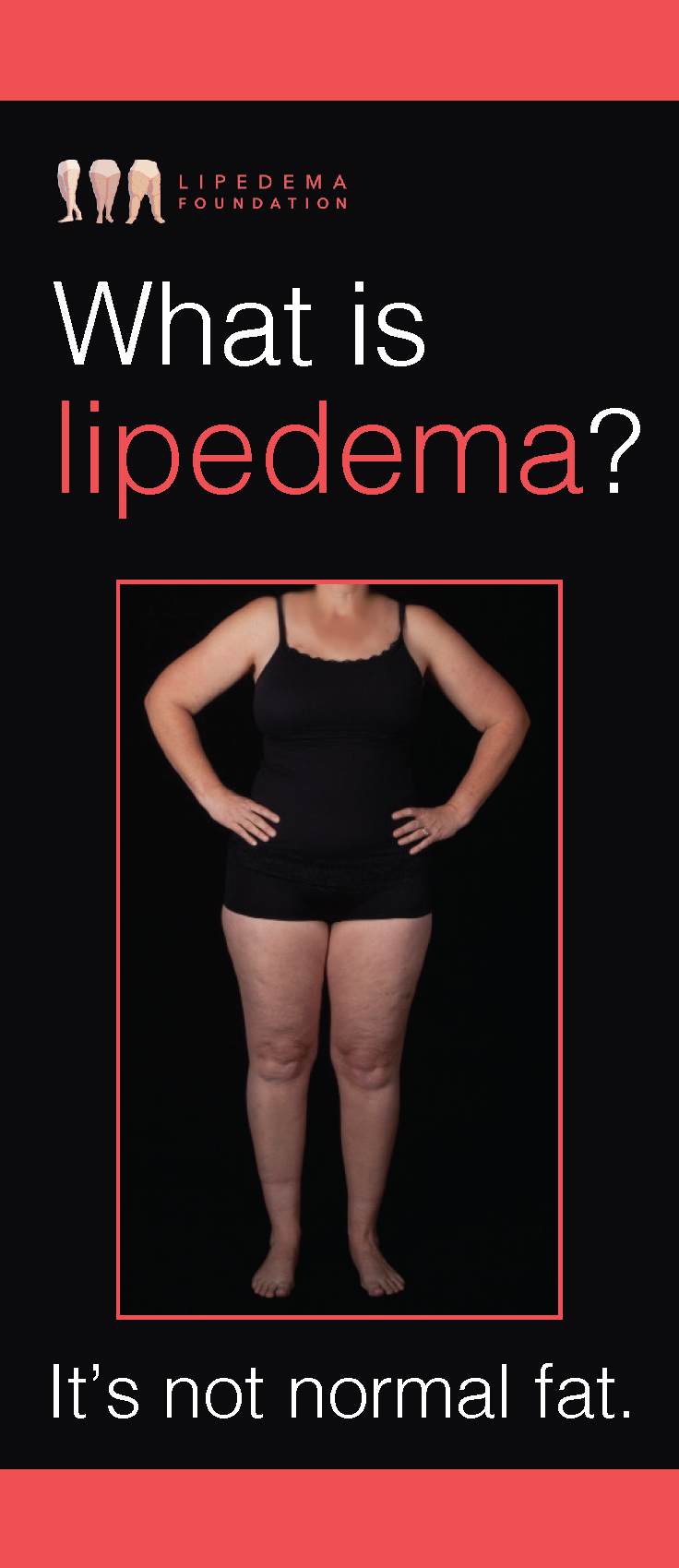 Lipedema (also known as Lipoedema or Lipodema) is a pernicious