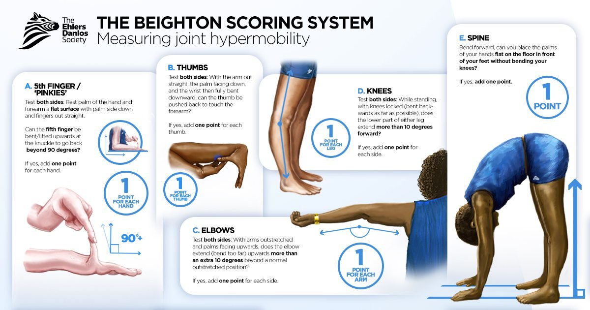 Image of the Beighton Score steps