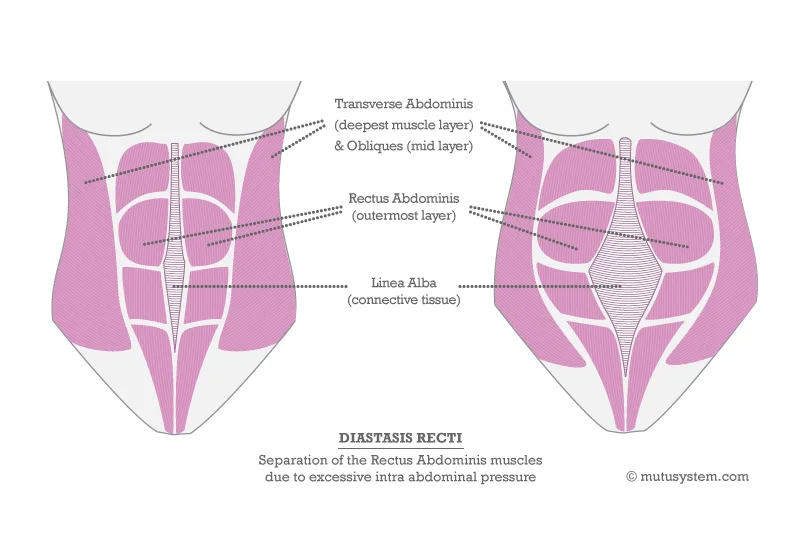 Diagram of Diastasis Recti Courtesy of MuTu Systems™