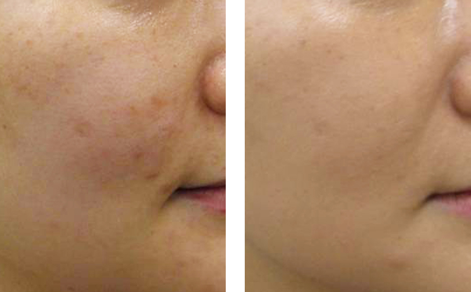 LEFT: BEFORE // AFTER: 1 SQ (under the skin) PRP PROCEDURE, 6 WEEKS POST-TREATMENT