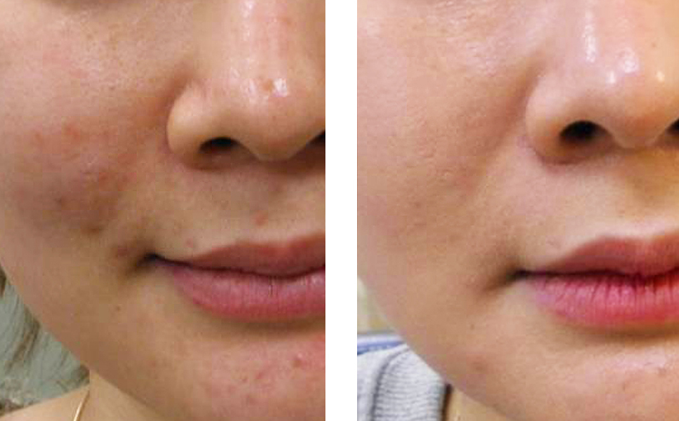 Left: Before // After: 1 SQ (under the skin) PRP Procedure, 6 weeks post-treatment