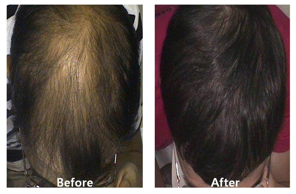 2 PRP PROCEDURES, 4 WEEKS APART. AFTER PHOTO IS 6 MONTHS POST FIRST PROCEDURE.