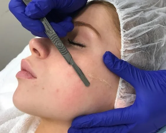 Derma planing an exfoliating process where a sterile blade is carefully brushed a top skin to gently remove dead skin cells and vellus hair (fine facial hair or “peach fuzz”). This non-invasive exfoliation technique immediately improves skin texture and tone. It is safe for nearly all skin types, non-invasive, and pain-free. It’s effective for men and women of all ethnicities and ages — even for pregnant or nursing women.