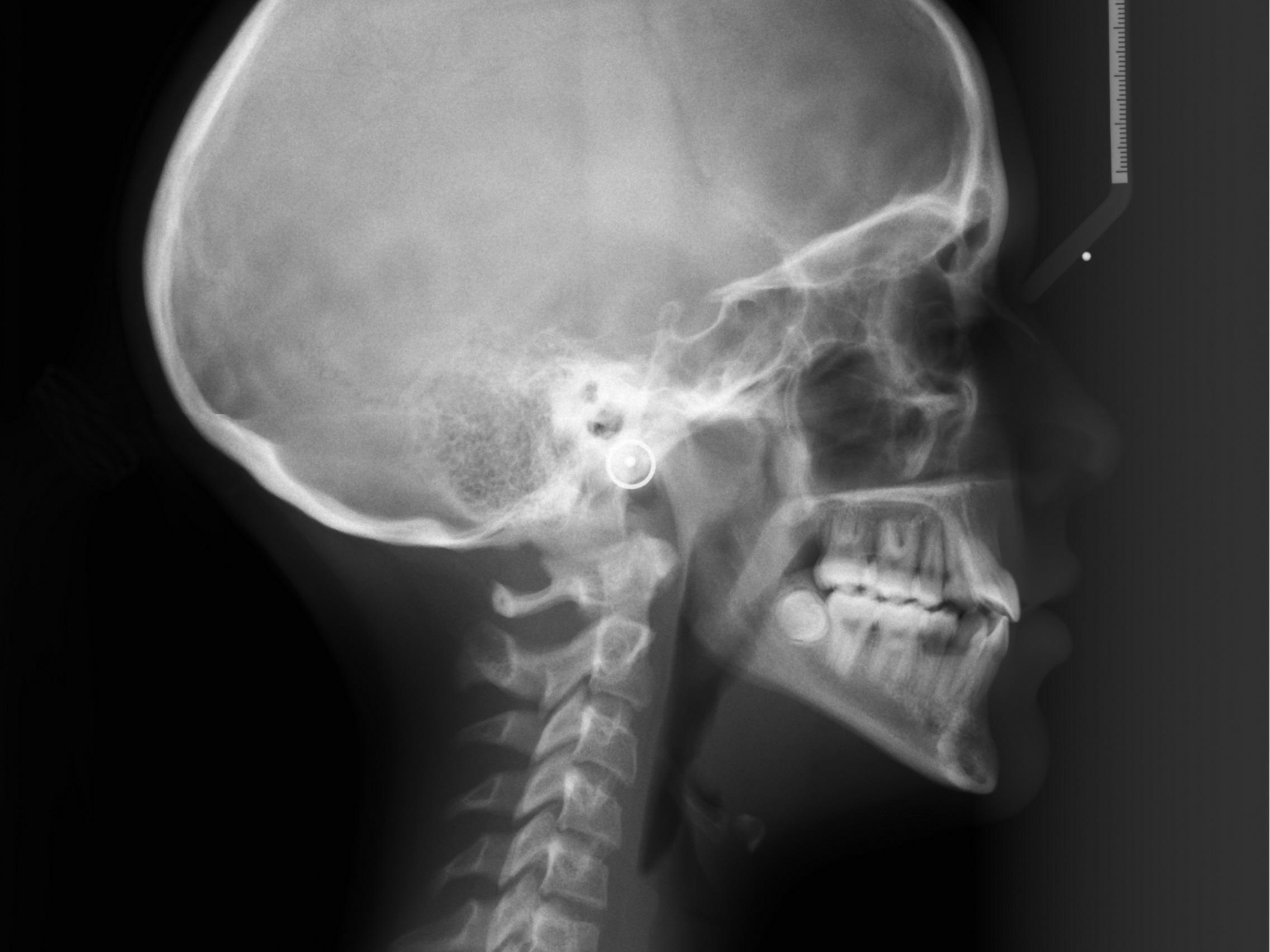 XPVT-D2655 - Jayne Carr - Final - X-ray Lateral.jpg
