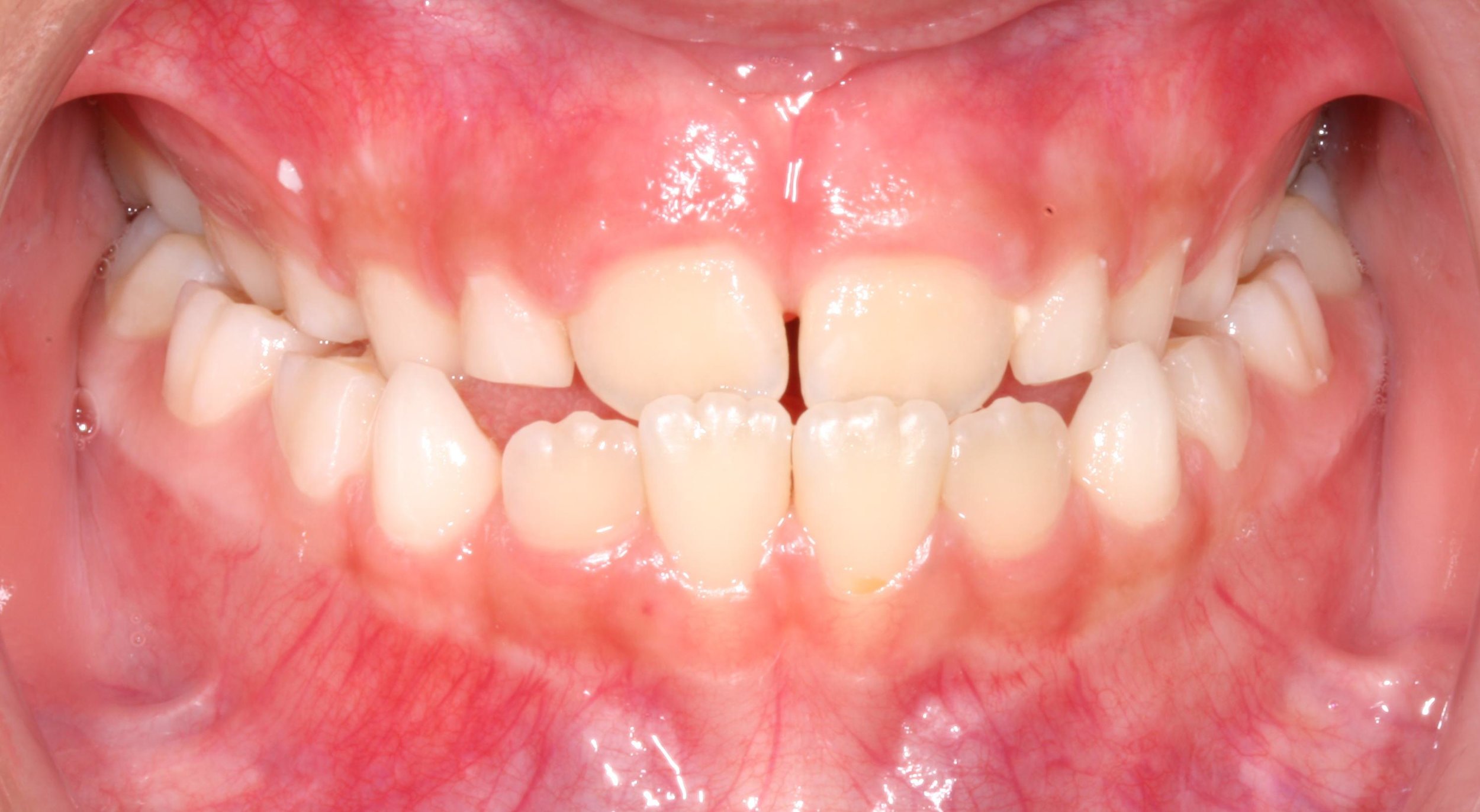 Underbite/posterior crossbite